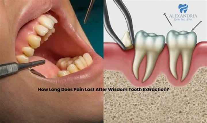 How long does pain last after C-section?