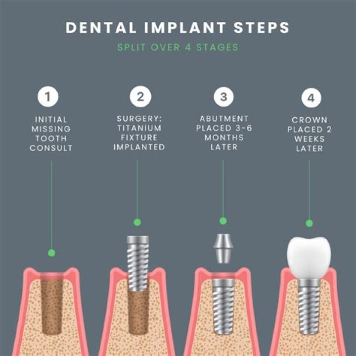 How long is the recovery for dental implants?