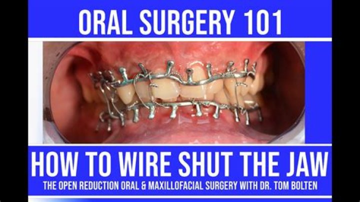 How long is your mouth wired shut after jaw surgery?
