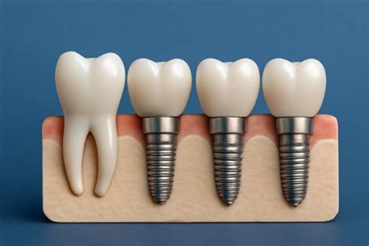 How long should a dental implant last?