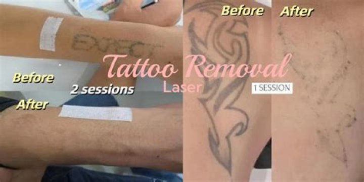 How many sessions does it take to remove a red tattoo?