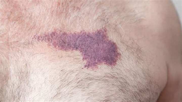 How many treatments does it take to remove port-wine stain?