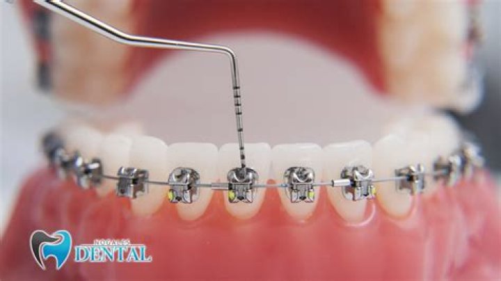 How often do braces get tightened?