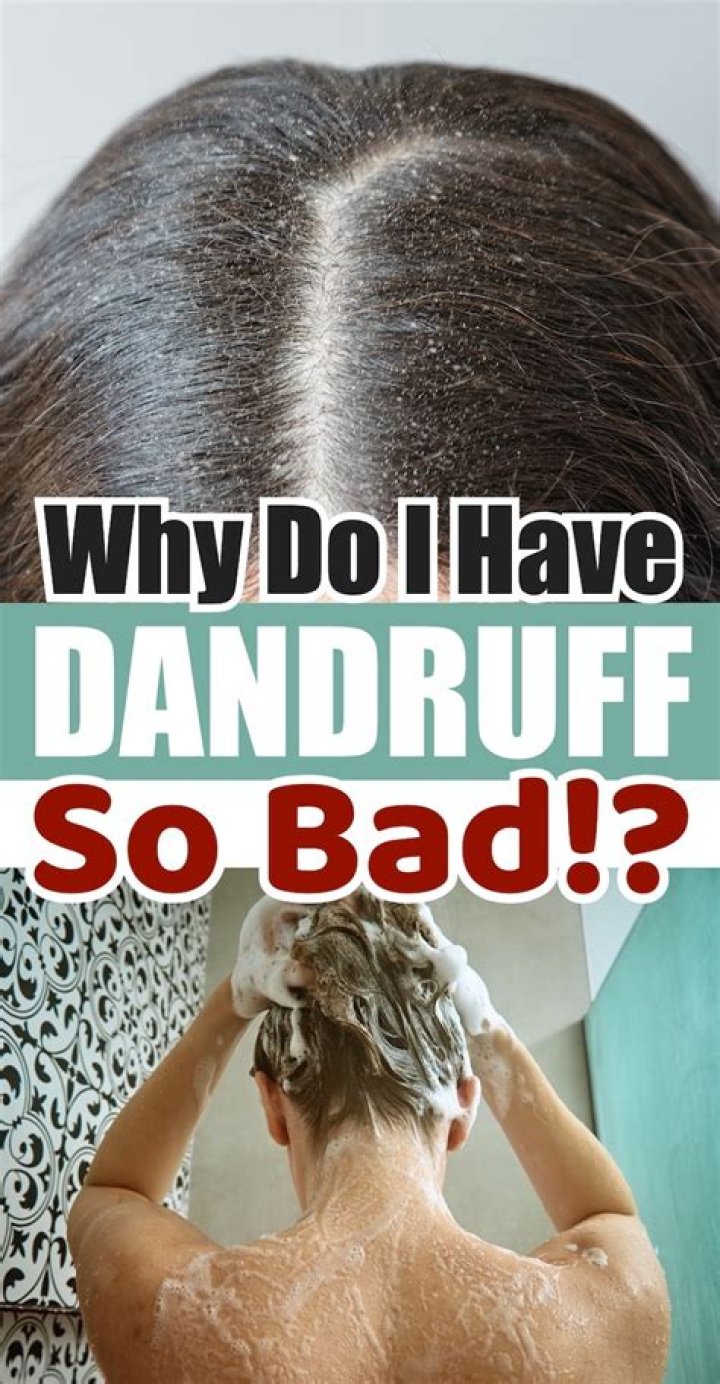 How often should I shampoo if I have dandruff?