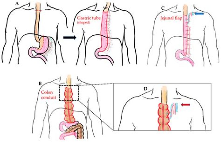 How serious is narrowing of the esophagus?
