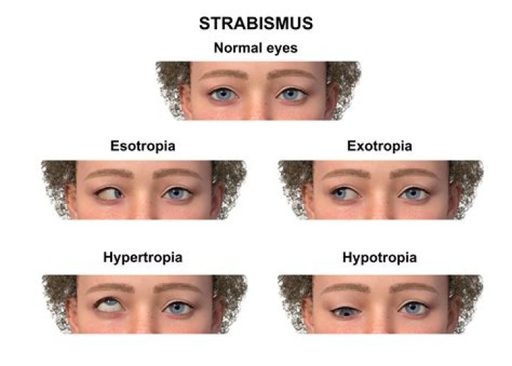 How serious is strabismus?