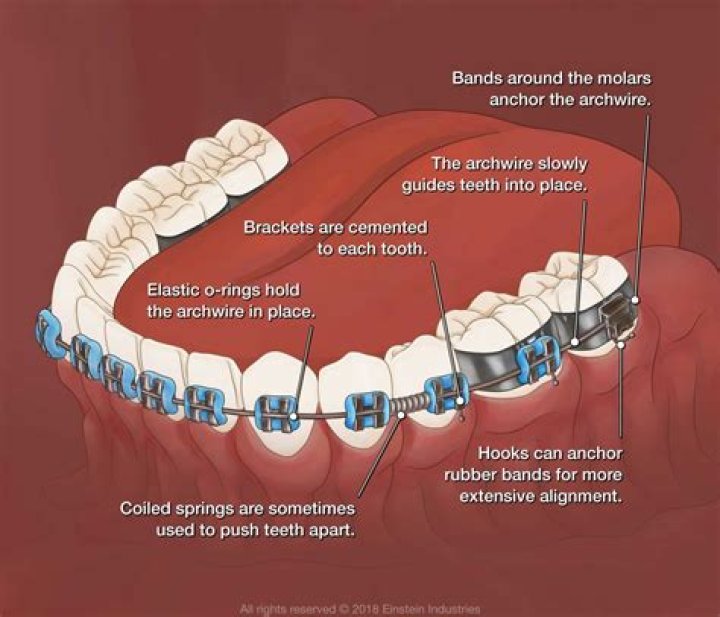How strong is the braces glue?