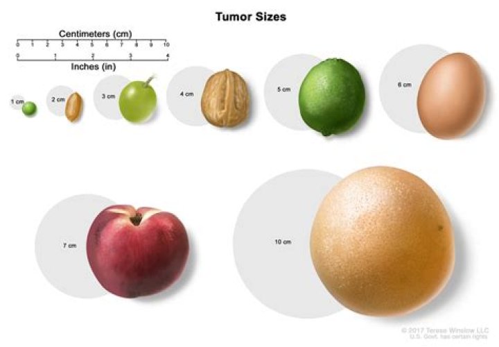 Is a 5 cm mass large?