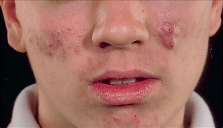 Is acne at 17 normal?