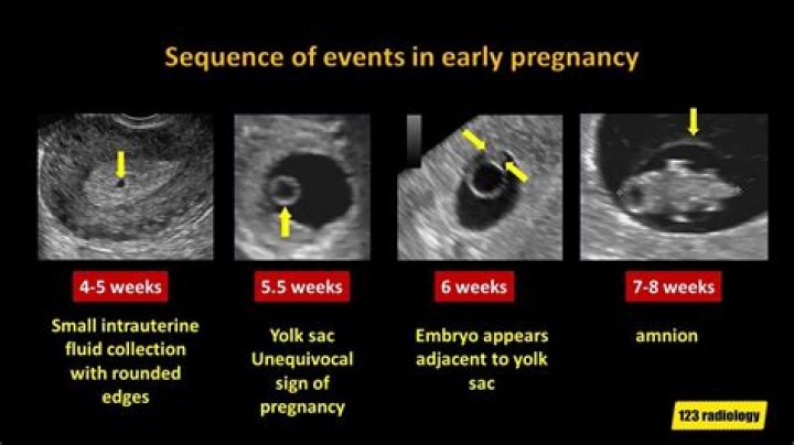 Is an empty sac at 6 weeks normal?