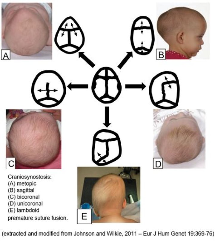 Is craniosynostosis covered by insurance?