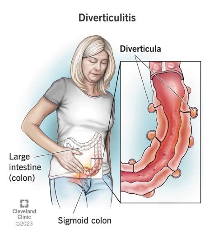 Is diverticulitis stress related?
