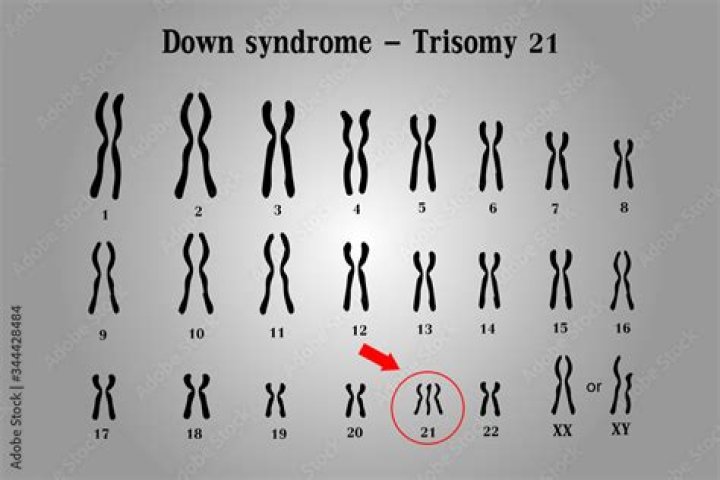Is Down syndrome genetic?