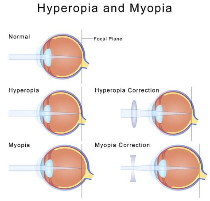 Is hyperopia and hypermetropia the same?