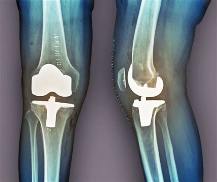 Is knee replacement a major surgery?