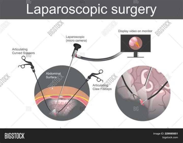 Is laparoscopy a major surgery?