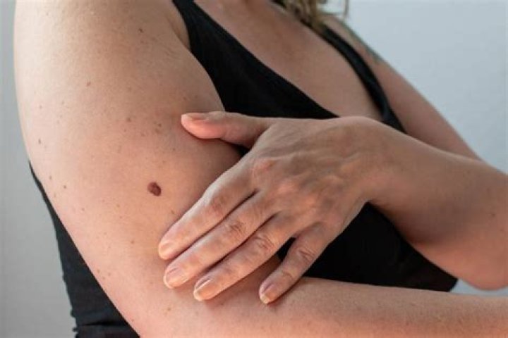 Is melanoma removal painful?