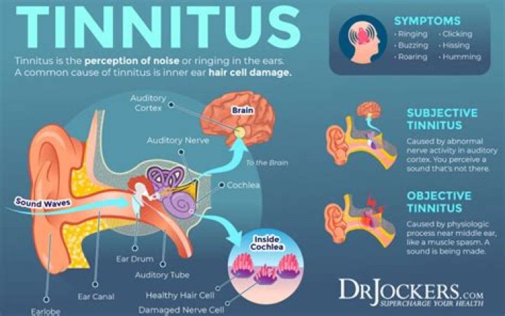 Is my tinnitus spike permanent?