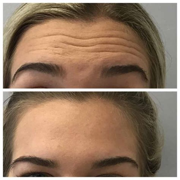 Is Retinol Good for forehead wrinkles?