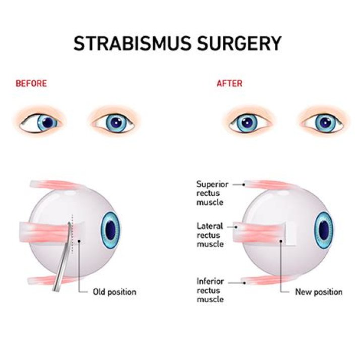 Is strabismus a cosmetic surgery?