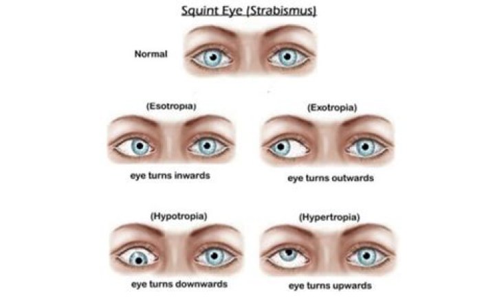 Is strabismus and squint the same?