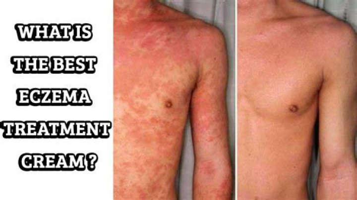 Is there a pill for eczema?