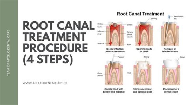 Is there an alternative to getting a root canal?