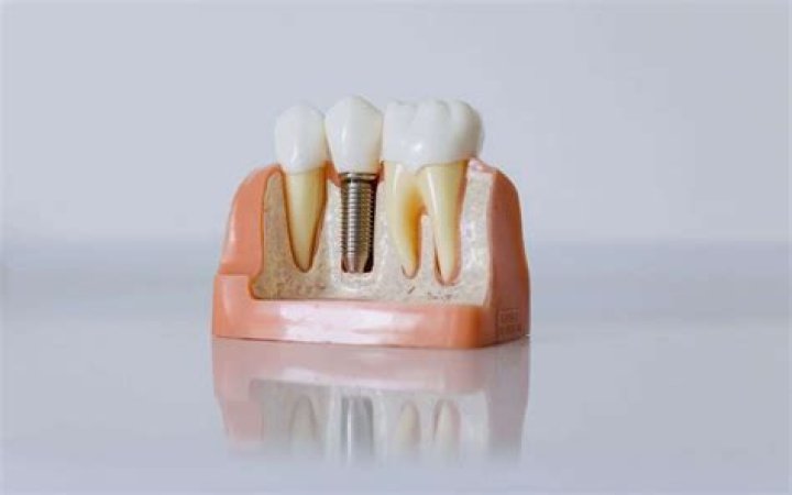 Is there an alternative to root canal?