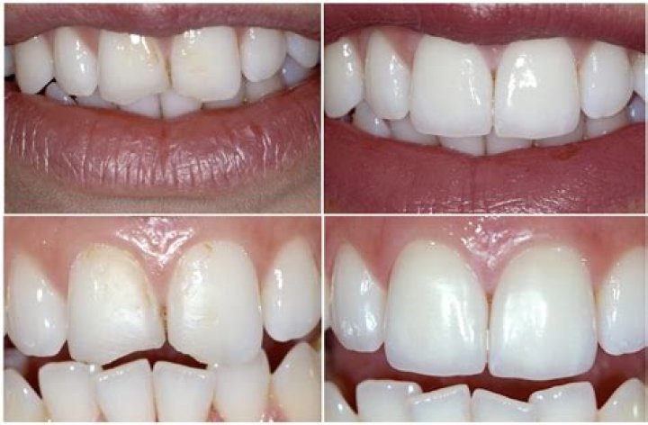 Should I brush my teeth after oil pulling?