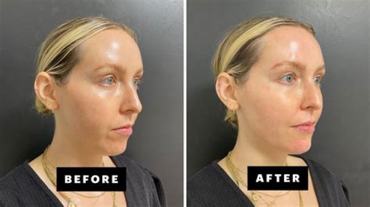 Should I massage chin filler?