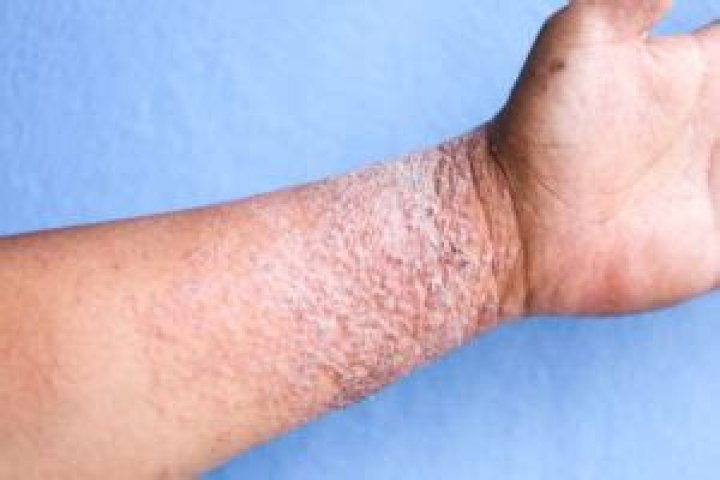 Should you cover eczema or let it breathe?