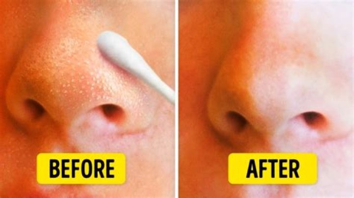 Should you extract blackheads?