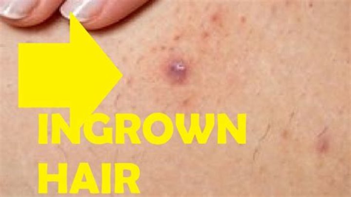 Should you pull out ingrown hairs?
