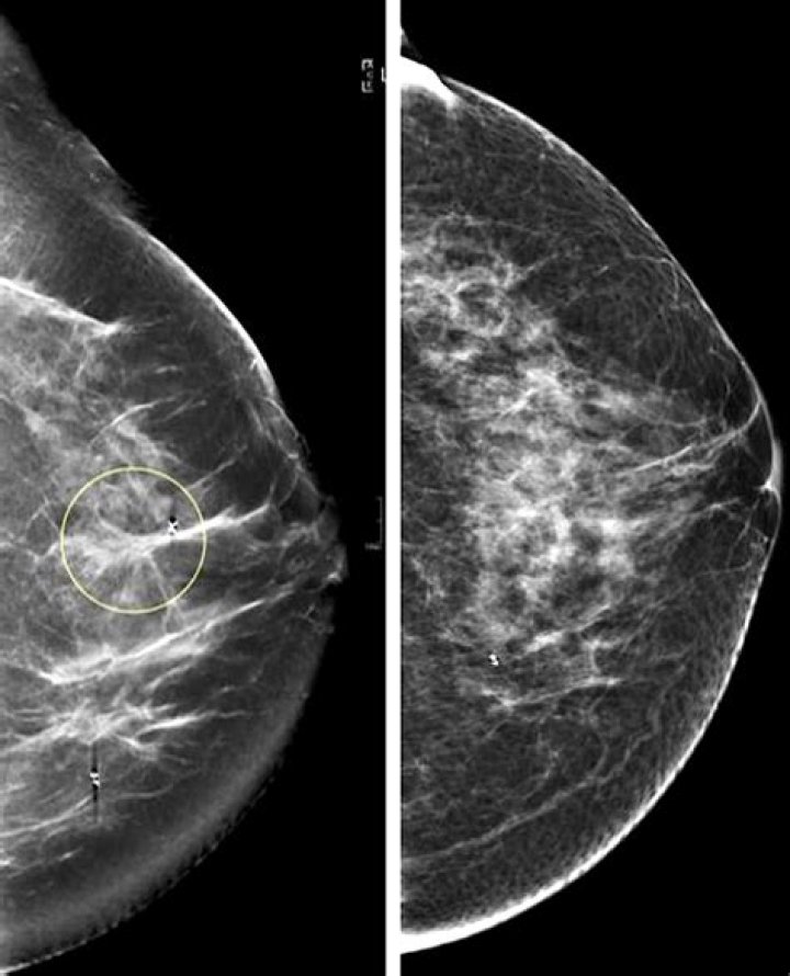 What a breast bud looks like?