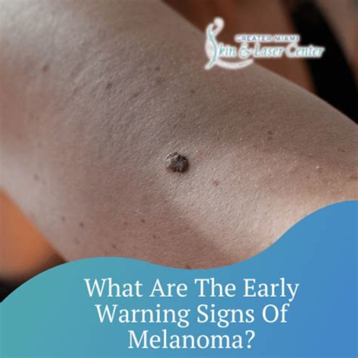 What are the early warning signs of melanoma?