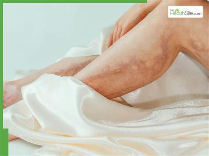 What are the symptoms of blocked arteries in the legs?