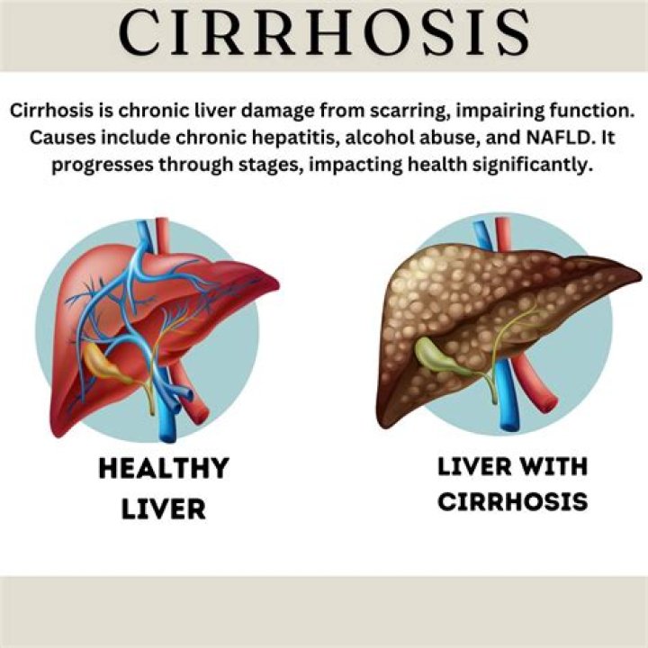 What are the symptoms of stage 4 cirrhosis of the liver?