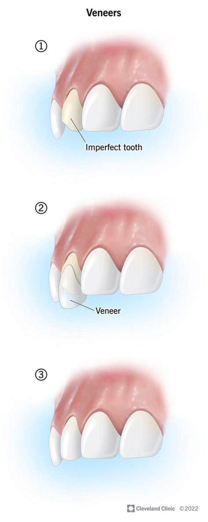 What are veneers for teeth?