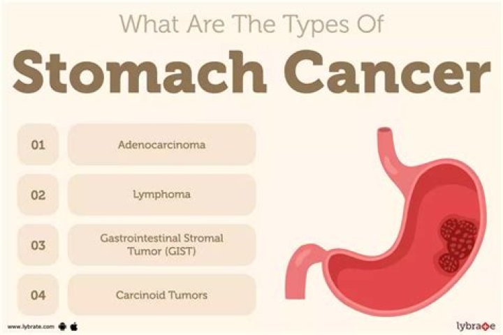 What can be mistaken for stomach cancer?