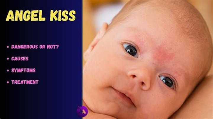 What causes angel kisses on babies?