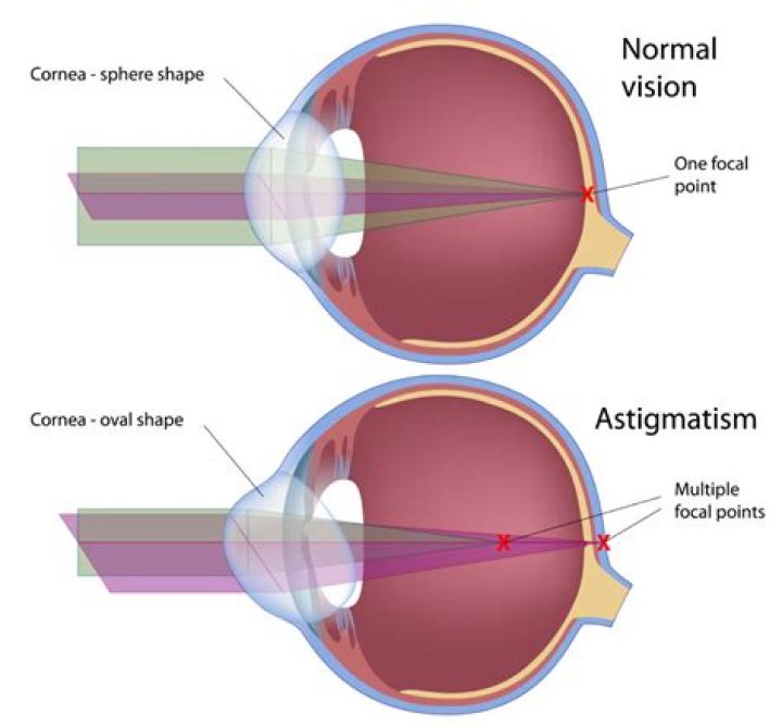 What causes astigmatism later in life?