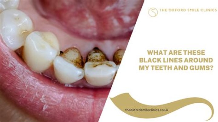 What causes black spots on teeth near gum line?