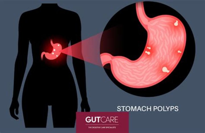 What causes polyps in your stomach?