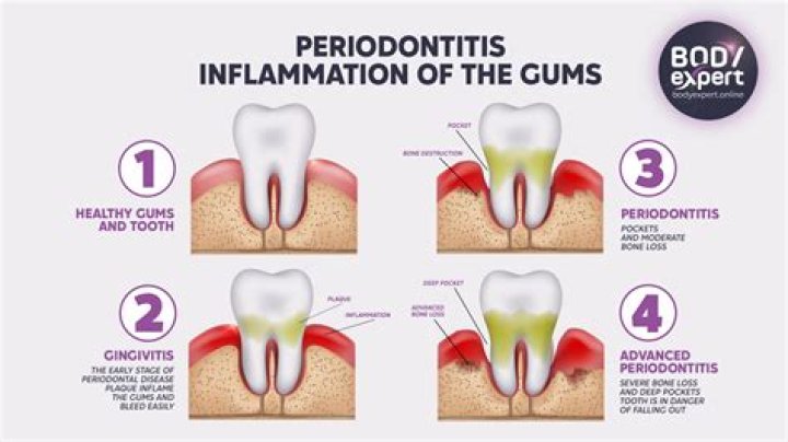 What causes sudden periodontitis?