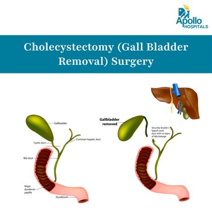 What clothes to wear after gallbladder surgery?