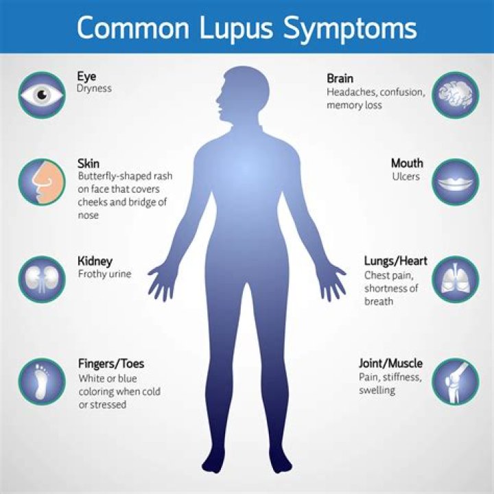 What condition is similar to lupus?