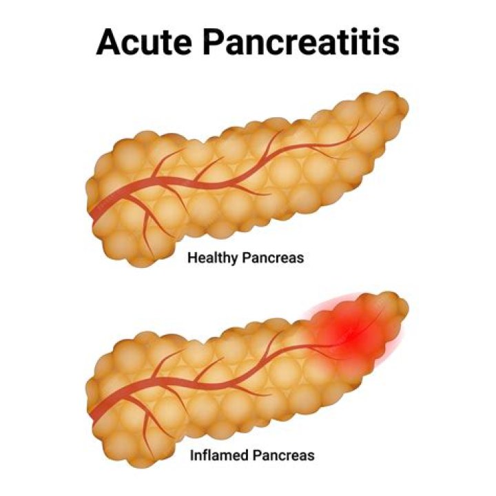 What cures pancreatitis?