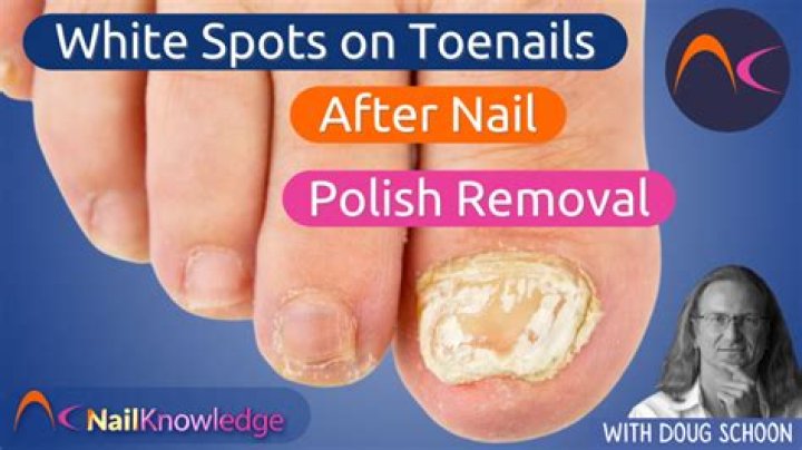 What do black marks on toenails mean?