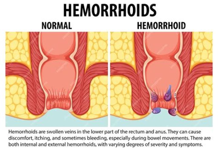 What do hemorrhoids do?
