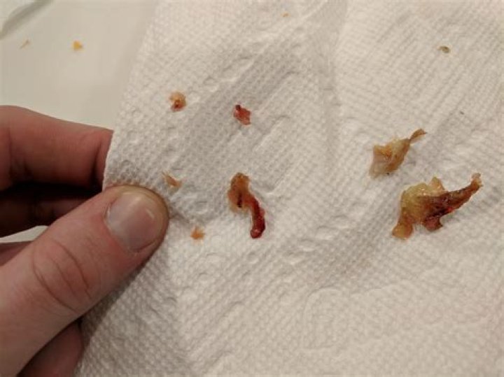 What do nasal polyps smell like?